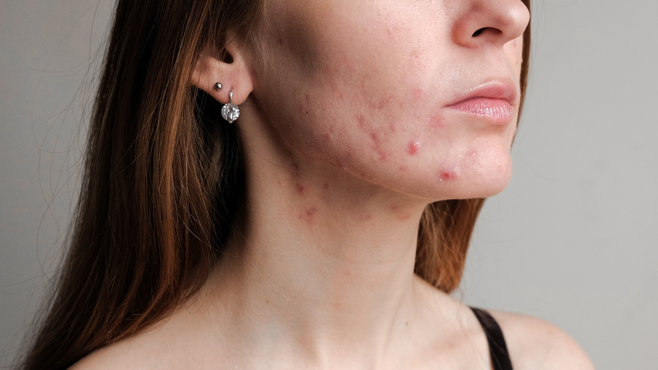 I'm breaking out, but my skincare routine hasn't changed!