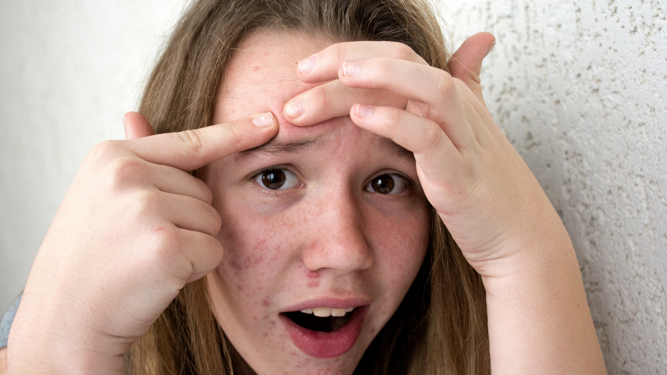 Help! My Teenager is asking to start on roaccutane!