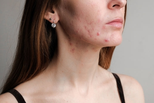 woman with acne on chin