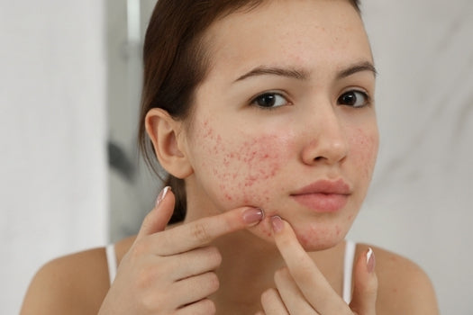 teenage girl popping pimples in mirror