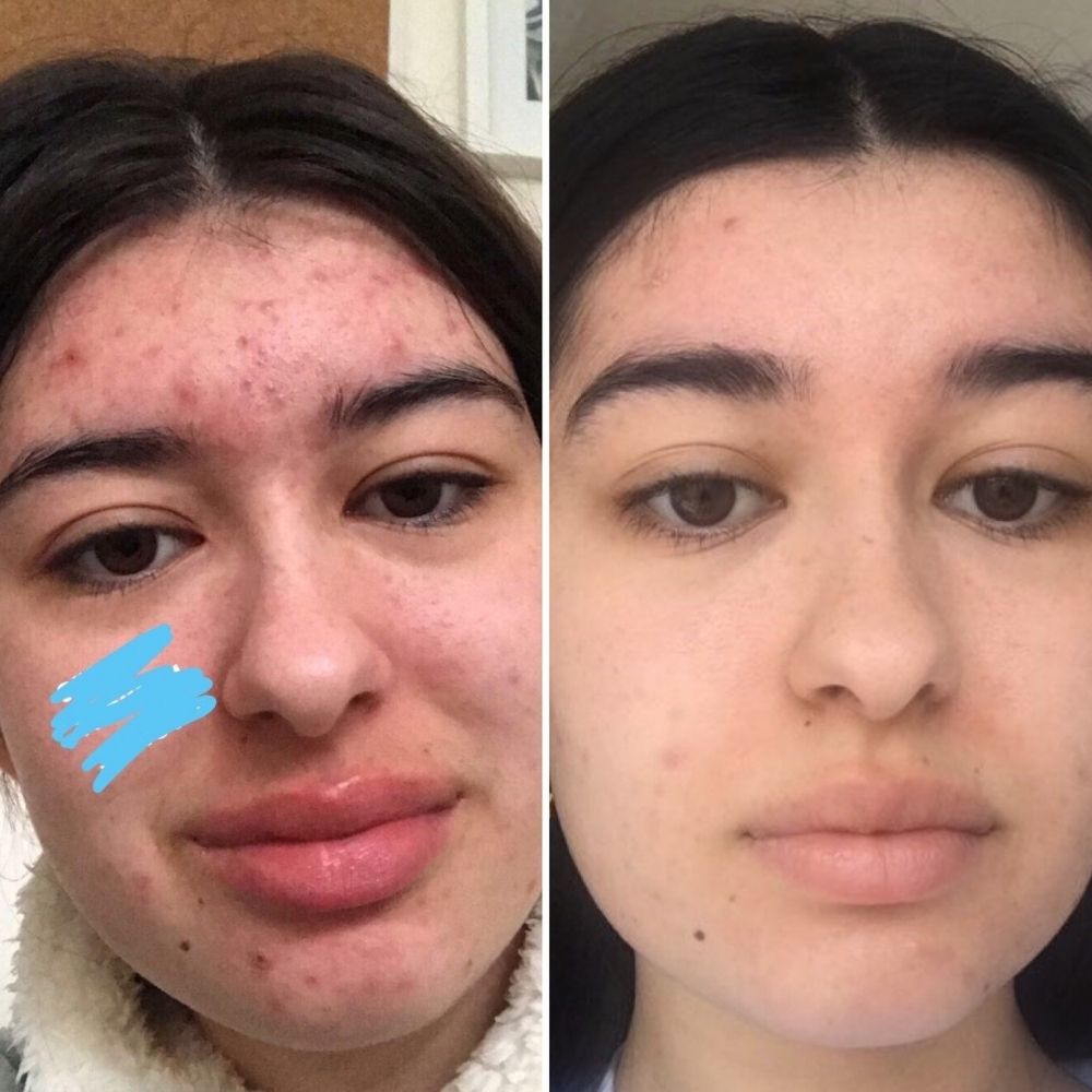 Acne and combination skincare before and after front view showing improved skin clarity