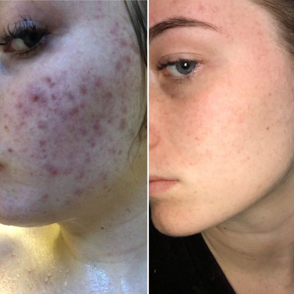cne and combination skincare before and after side profile showing clearer skin