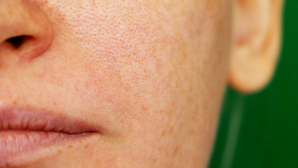 Battling with blackheads and enlarged pores?