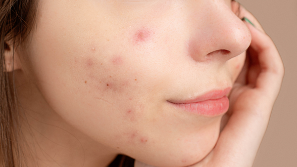 Stop exfoliating if you want to get rid of acne
