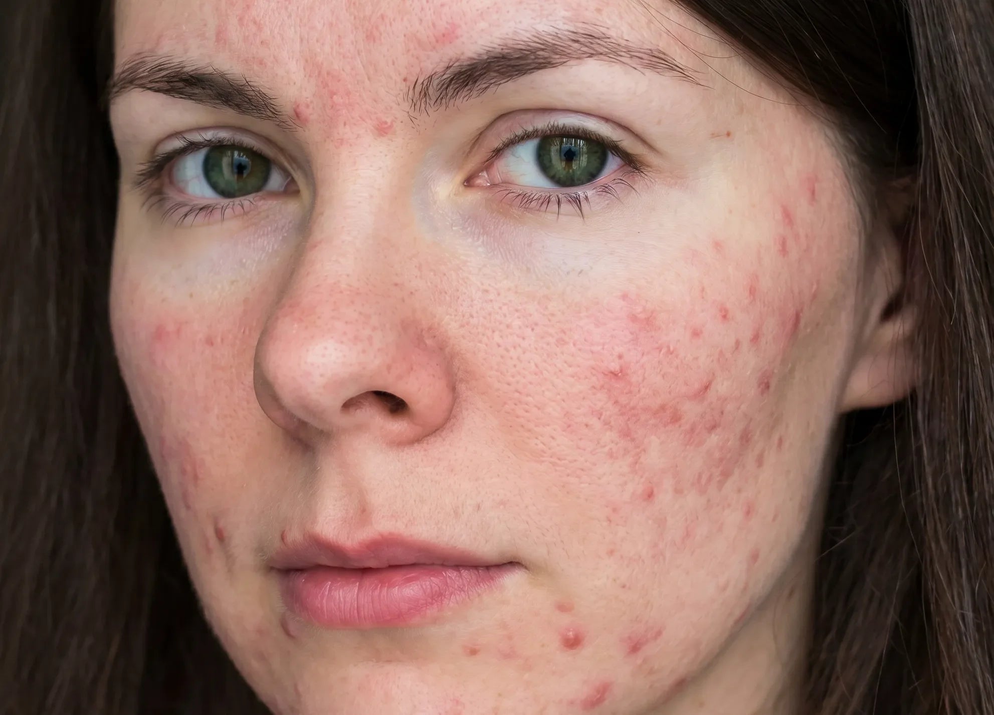 Rosacea Myths: 10 Facts About Causes, Triggers & Care | LOVESKIN