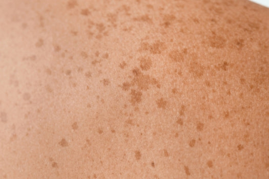 skin sun spots on shoulder
