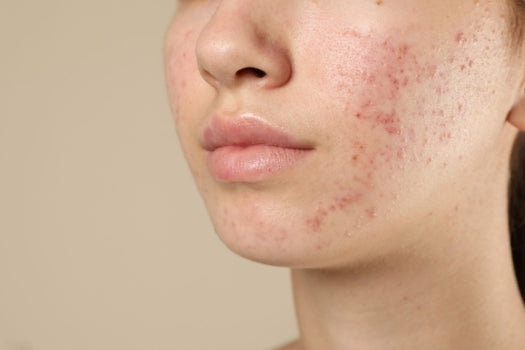 teenager face with acne