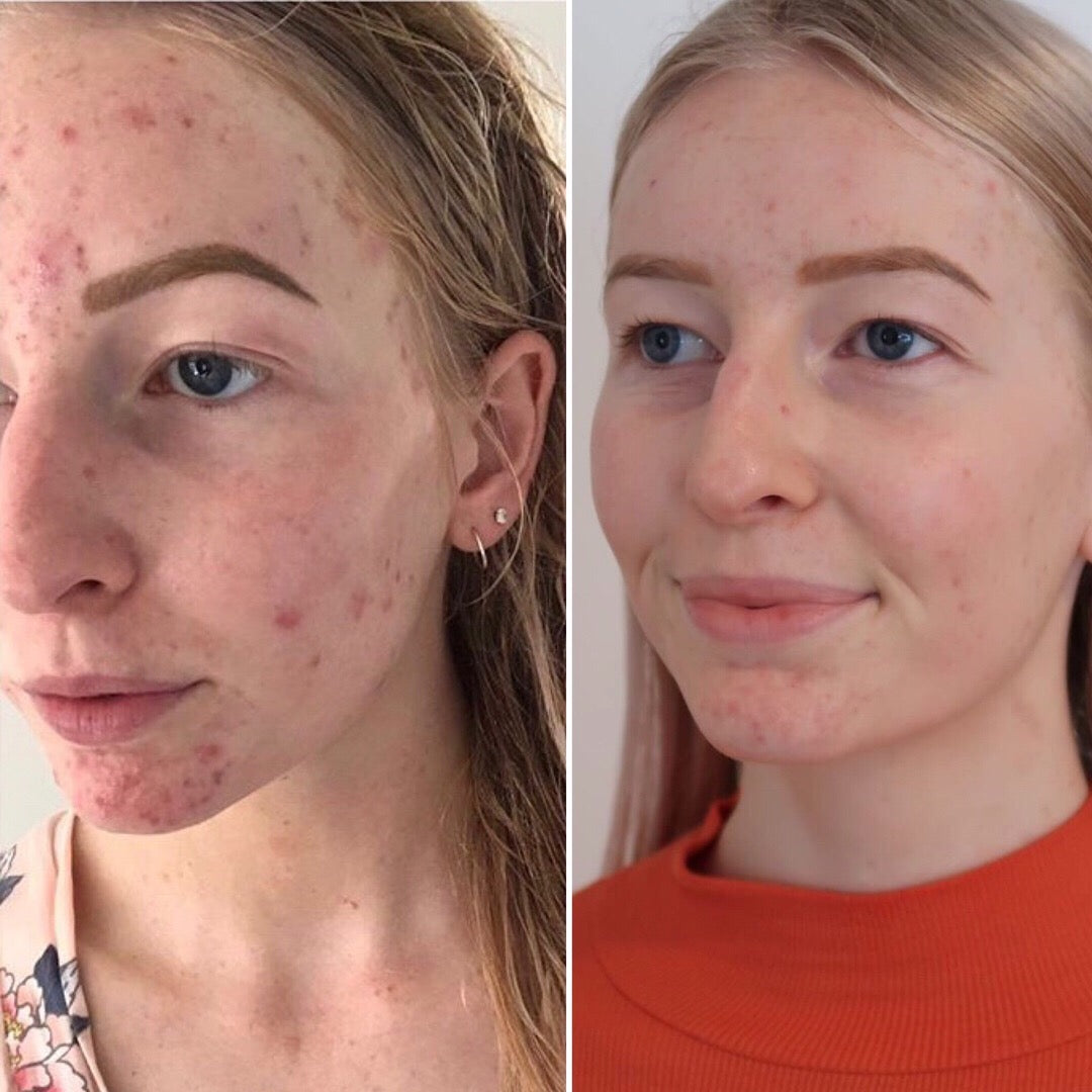 Before and After_Katie: Demonstrating significant improvement in hormonal acne with the use of LoveSkin ritual for acne/combination skin.