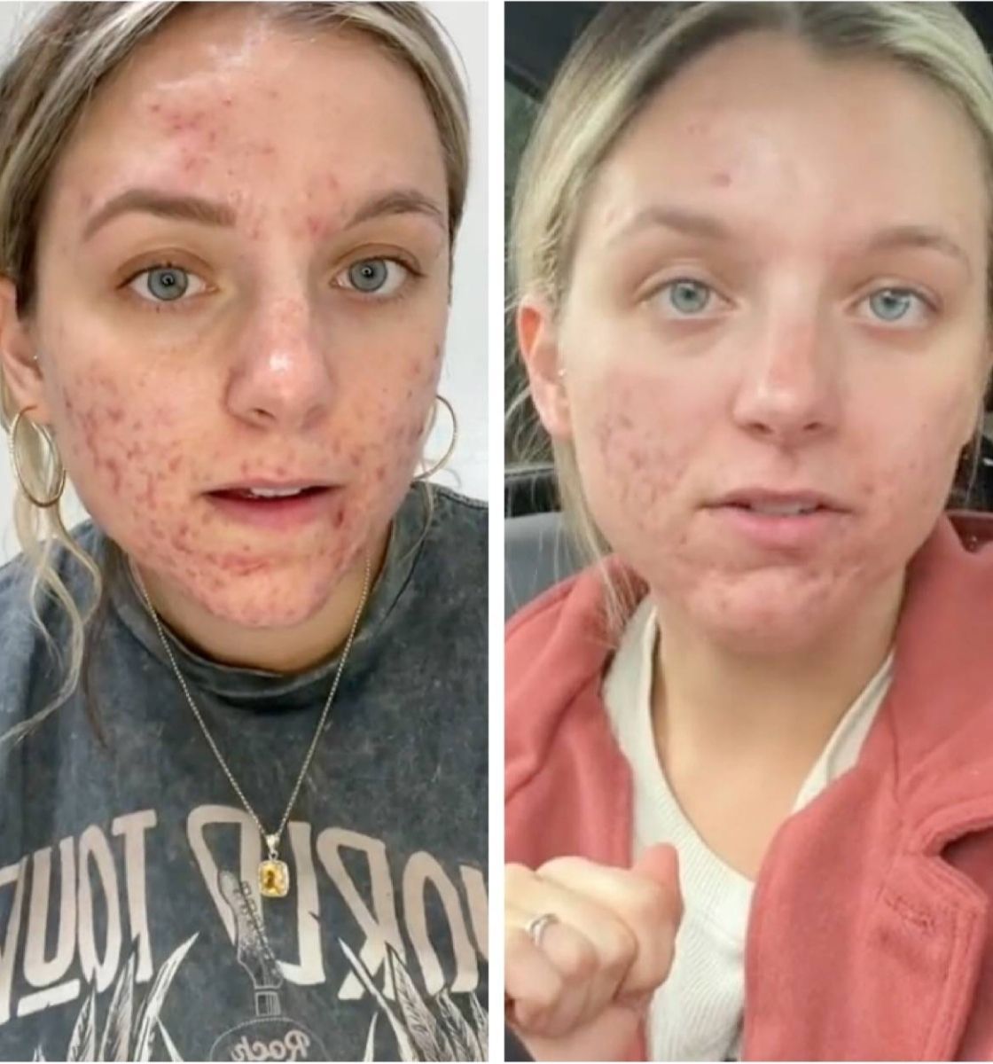 Lexi skin transformation using LoveSkin products