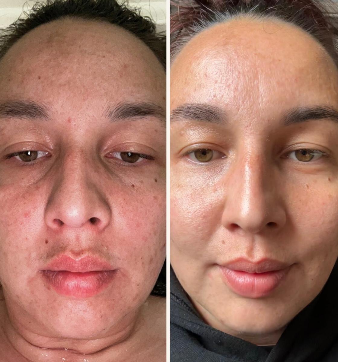 Michelle's skin glowing after using LoveSkin products
