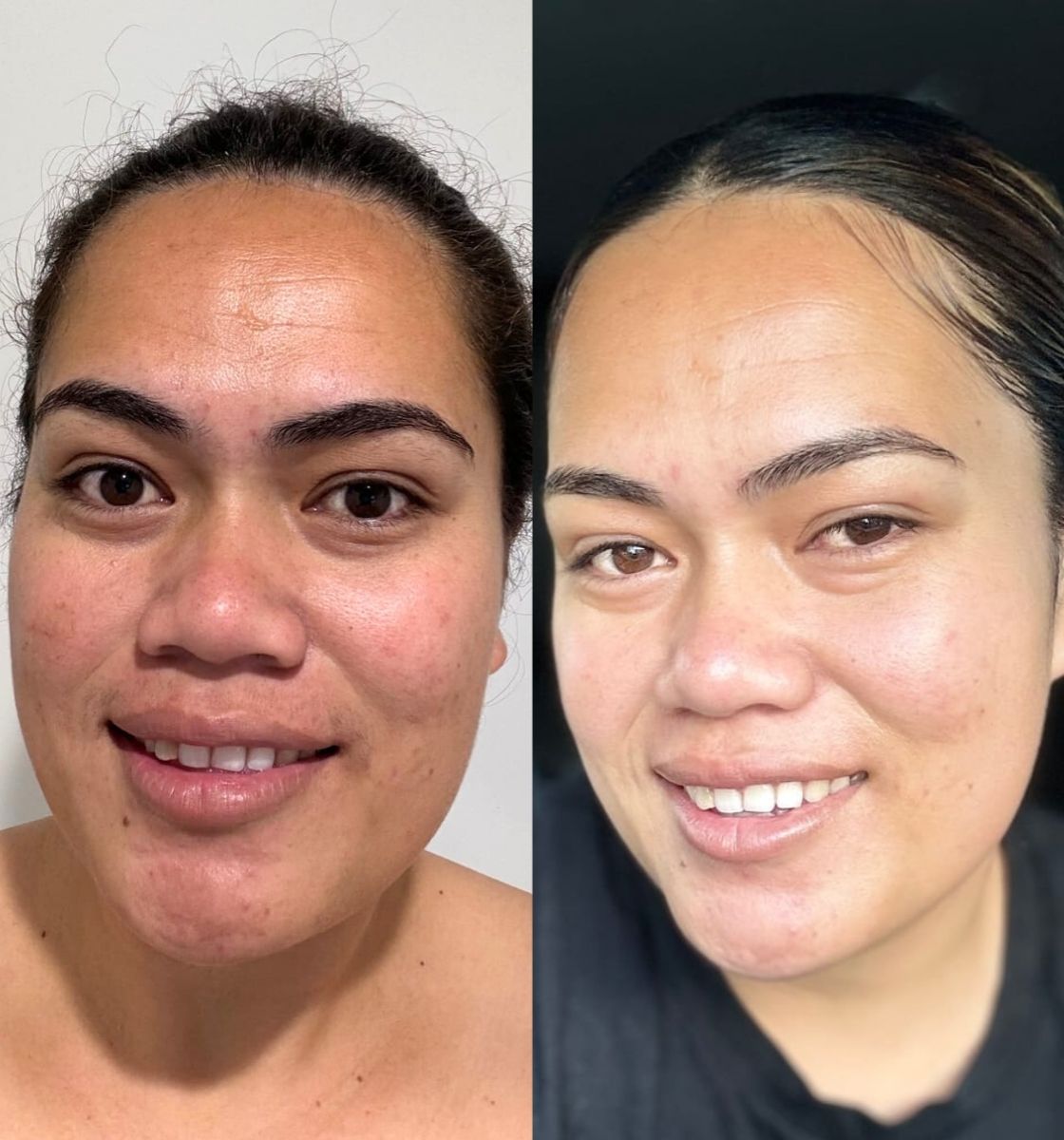 Molia skin transformation before and after using LoveSkin products