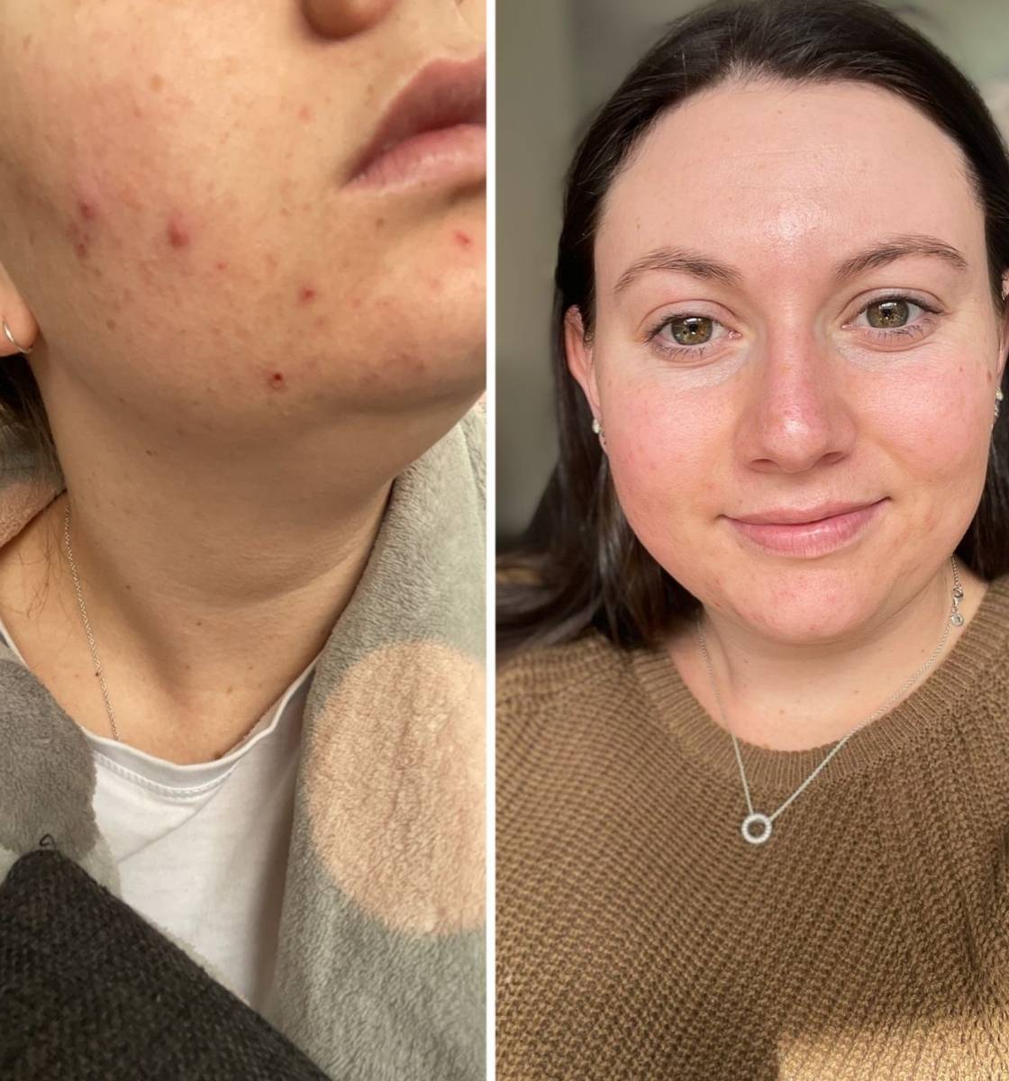 Pahneah skin transformation using LOVESKIN