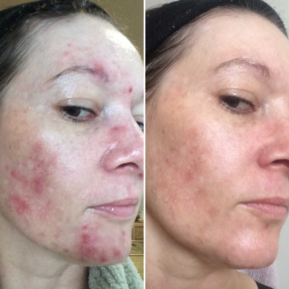 Before and after images using arohanui to reduce redness and improve skin tone