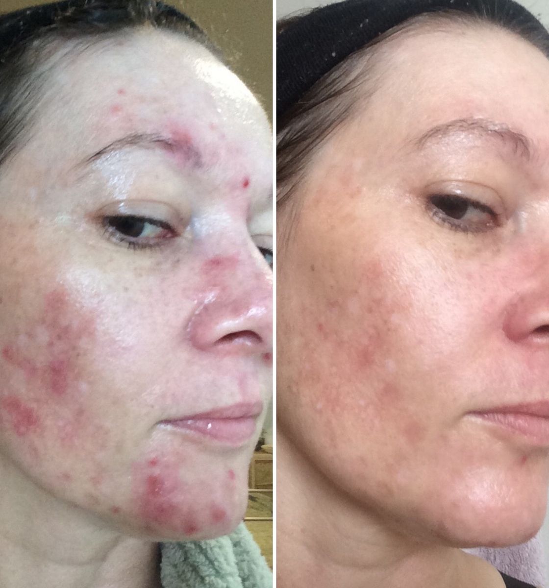 Sarah's acne transformation after using LoveSkin facial oils