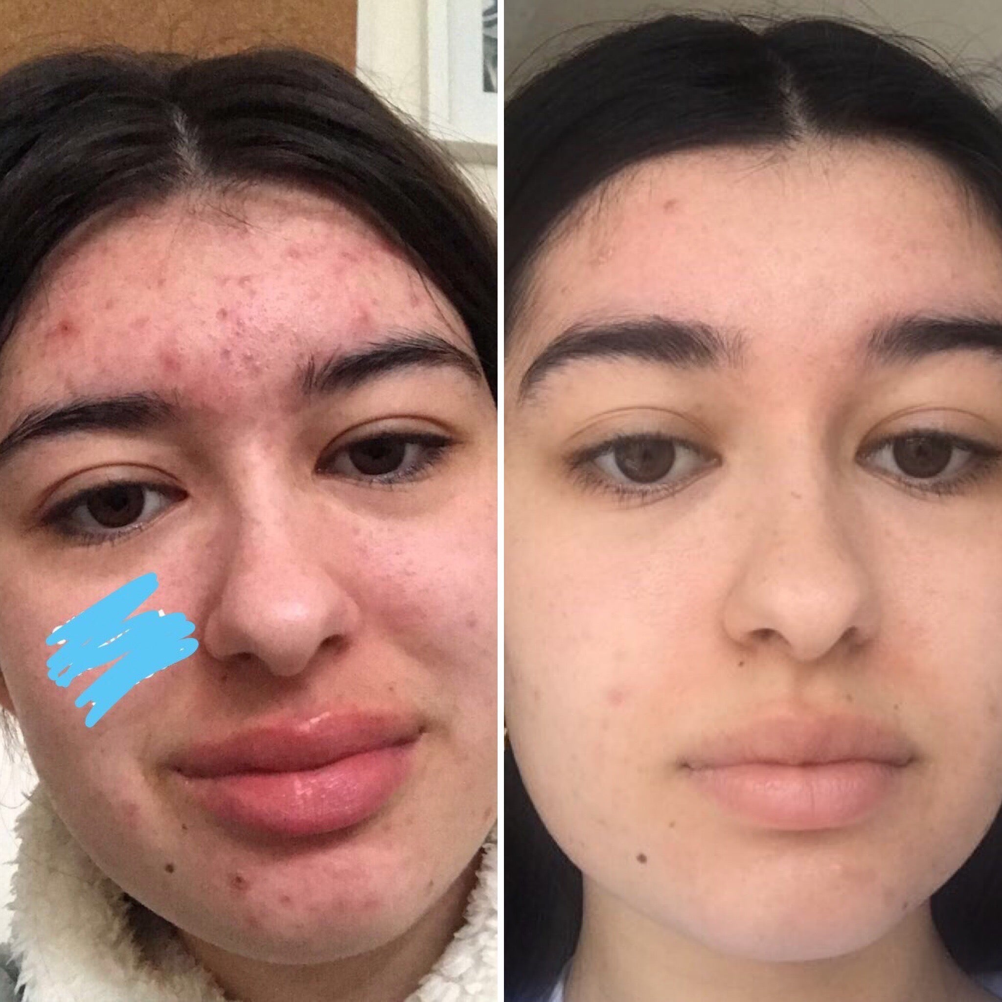 Acne improvement before and after LoveSkin skincare routine