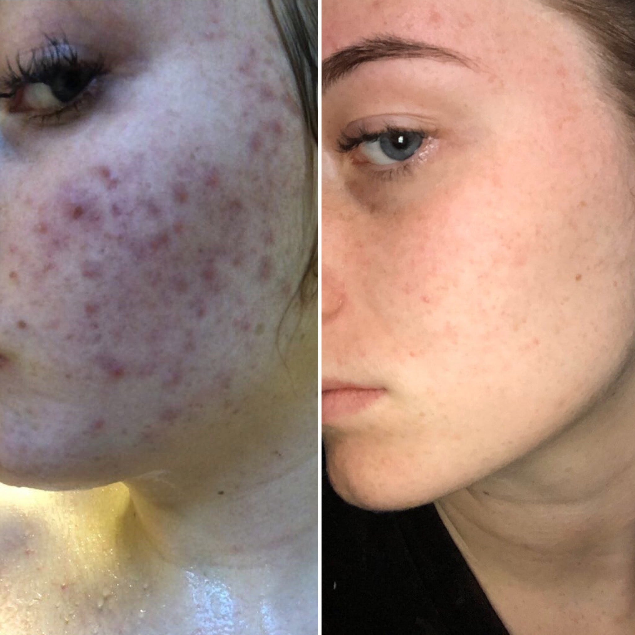 Skin transformation with LoveSkin facial serum, showing clearer, balanced skin